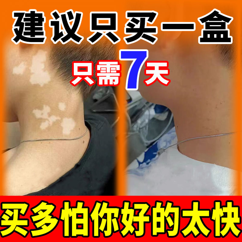 白癜外用快速消白斑专用补骨脂酊风特效黑色素生长软膏遮盖神器