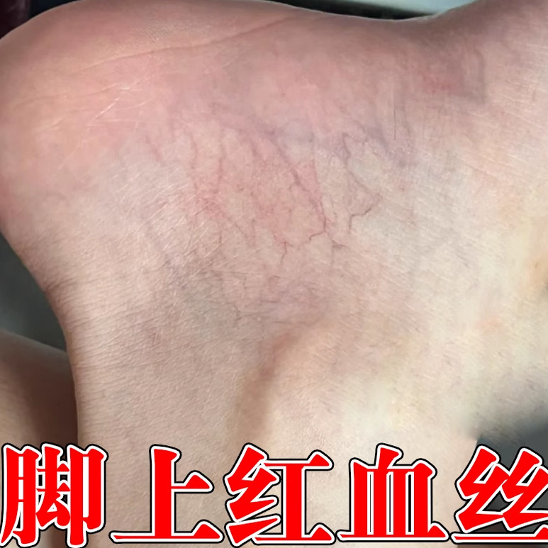 冷敷凝胶小腿青筋凸起蚯蚓腿肿胀下肢血管蚯蚓腿缓解药乳