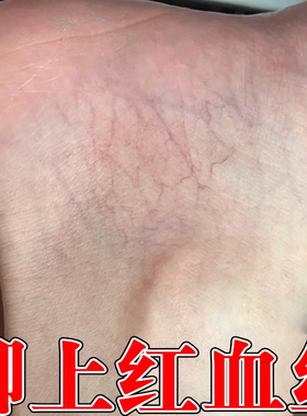 冷敷凝胶小腿青筋凸起蚯蚓腿肿胀下肢血管蚯蚓腿缓解药乳