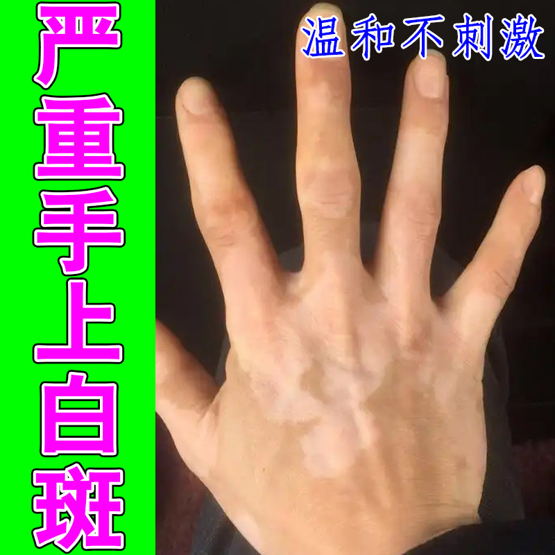 手臂局部浅色斑块身上肤色变淡印记小臂白点肢体色素不均白块大腿