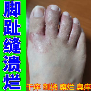 脚趾缝干痒脚趾缝发白专用修复药脚丫臭指缝开裂溃痒长水泡膏