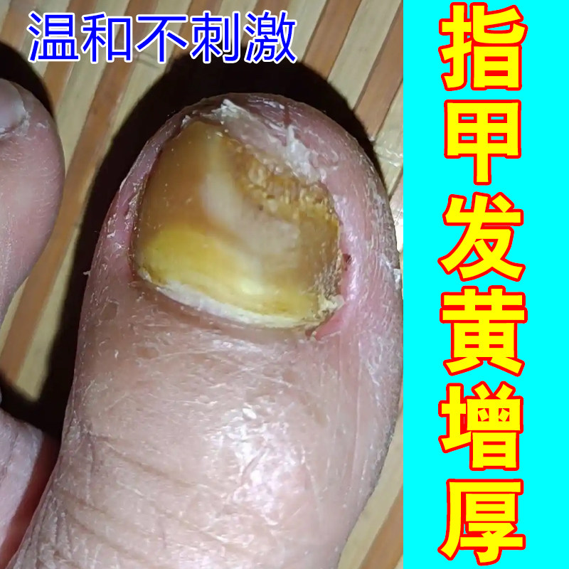 指甲发黄增厚甲肉分离空甲甲分层指甲发黄坏甲甲受损专用,彩妆/香水/美妆工具,美甲工具,淘宝优惠券,粉丝福利购,淘宝优惠卷
