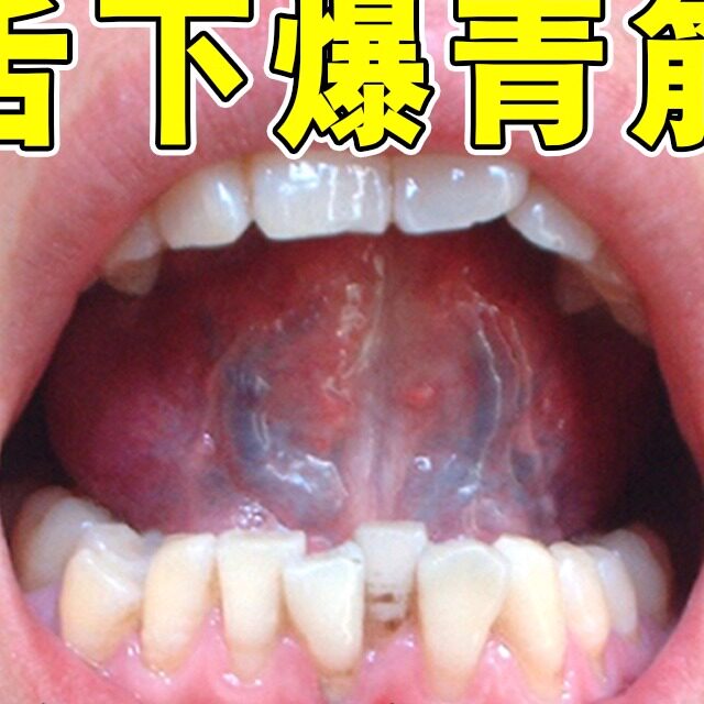 舌下爆青筋舌根青筋又黑又粗口腔溶栓液治舌根处疼痛血管堵塞血淤
