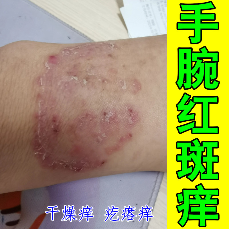 手腕红斑痒换季过敏痒长痘痘疙瘩皮肤粗糙冶紫外线皮肤红肿干燥痒