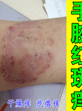 手腕红斑痒换季过敏痒长痘痘疙瘩皮肤粗糙冶紫外线皮肤红肿干燥痒