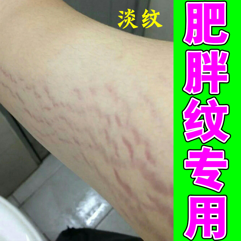 去肥胖纹修复霜生长纹消除大腿学妊娠纹护理