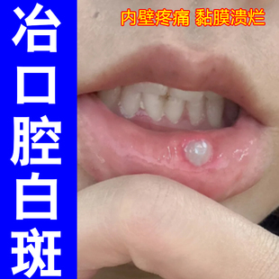 口腔白色念珠口腔菌唇舌黏膜白斑糜烂烧灼感口干扁平溃烂草本喷剂