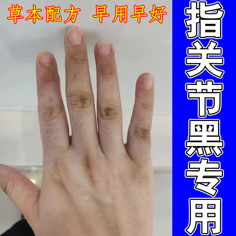 去指关节黑皮肤粗糙去角质手指暗沉指节干燥有关节膝关节脖子黑黑