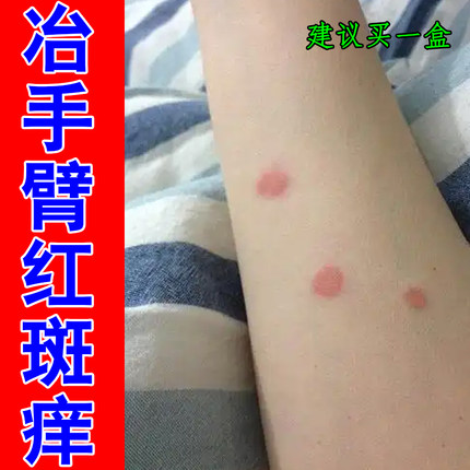 冶手臂红斑痒猫咪感染人得皮肤红斑起皮掉屑痒神经性紫外线过敏痒