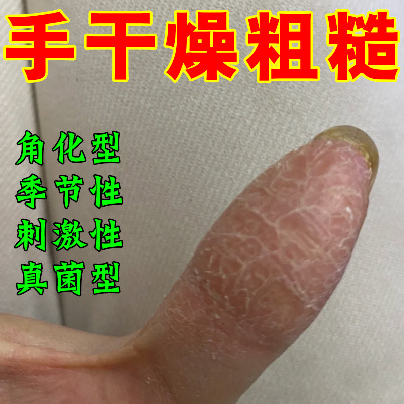 手干裂脱皮季节性儿童手蜕皮剥脱皮肤消毒护理（消）
