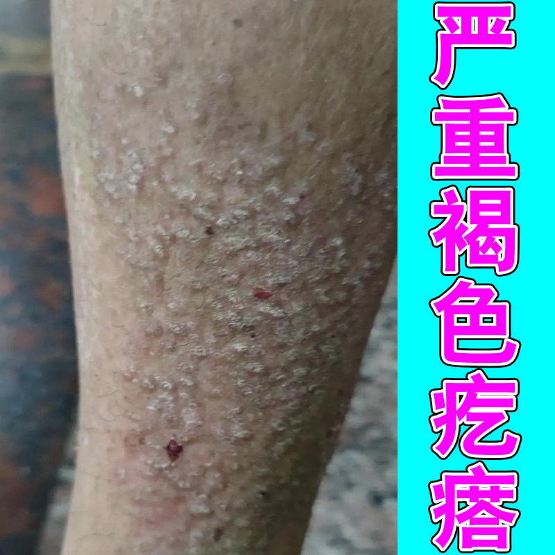 严重褐色疙瘩腿上起皮掉屑黑色素沉淀褐色蛋白沉积小腿后背顽固痒