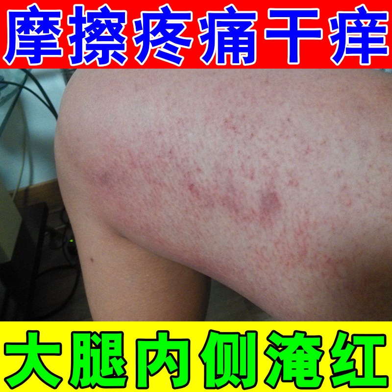防大腿内侧摩擦烧裆膏防胖人夏天烧裆男女大腿根摩擦出汗红肿刺痛