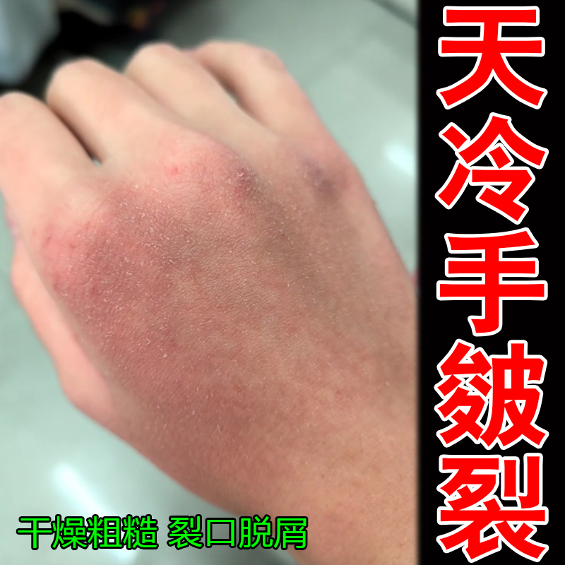 美隆尿素维E手部皲裂修复膏药乳