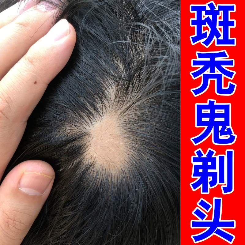 压力型斑秃头上秃块头发脱落头皮营养液草本养护发根稀疏男女头皮