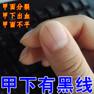 指甲有黑线手脚趾甲空甲长竖纹缺乏维生素营养不良指甲增厚易脱落