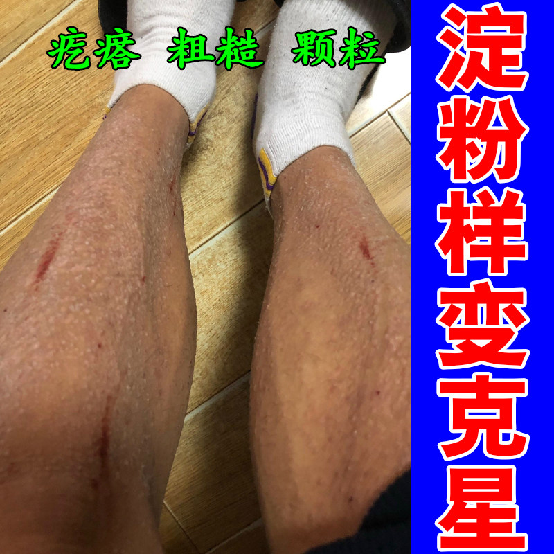 皮肤干燥小腿手上后背粗糙小颗粒干痒顽固苔变表面疙瘩糙