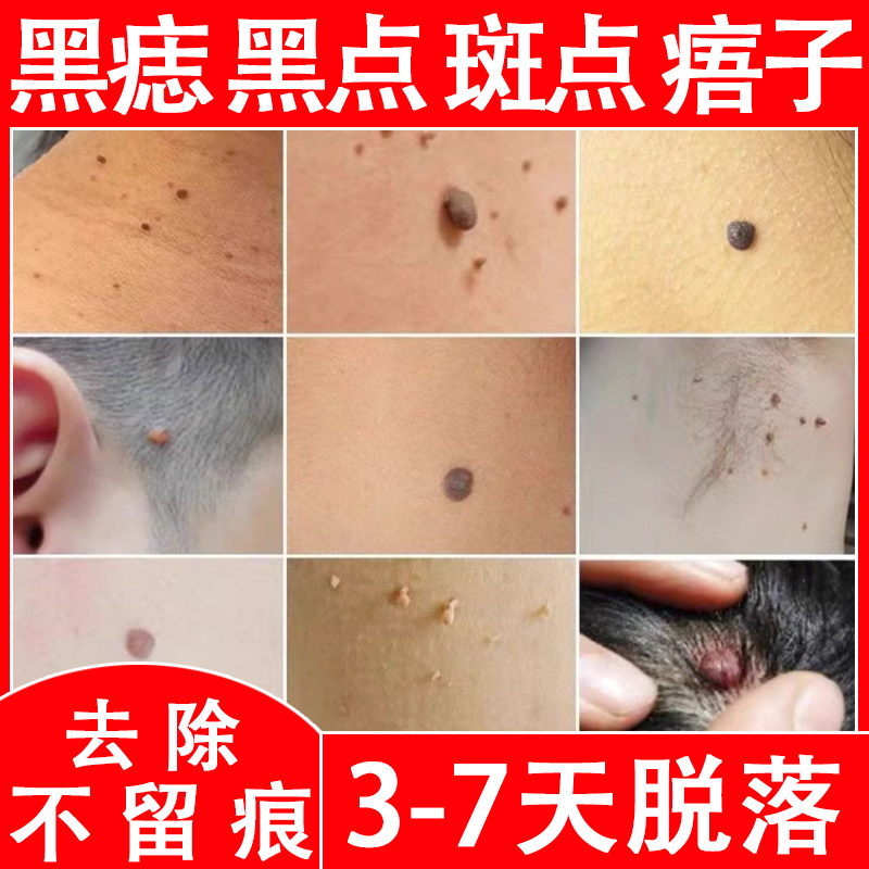 去脸上的黑志脸上黑点去除痣点志无痕药水正品脸部去志膏点痦子膏