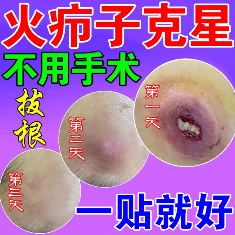 火疖子拔毒拔脓药膏贴治疗硬块粉瘤皮脂腺囊肿脓包坐板疮吸脓神器