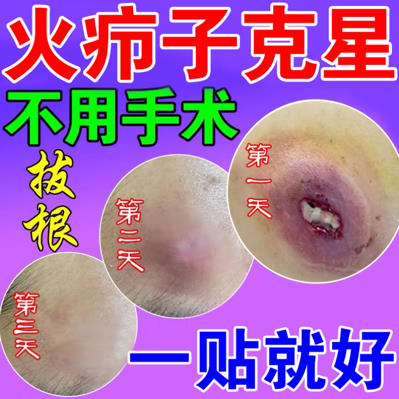 火疖子的治疗方法图片