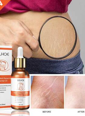 Stretch Marks Repair Essential Oil Skin Care Treatment Cream