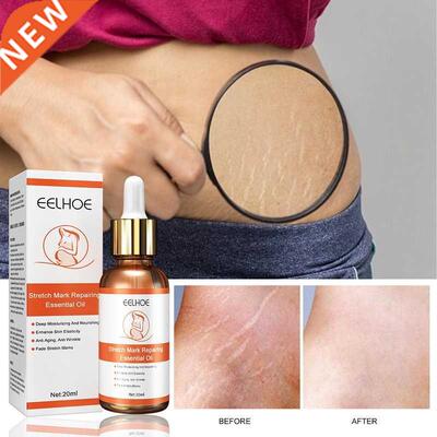 Stretch Marks Repair Essential Oil Skin Care Treatment Cream