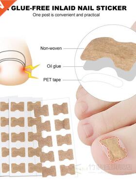 Ingrown Toenail Sticker Nail-Corrector Foot-Care Glue