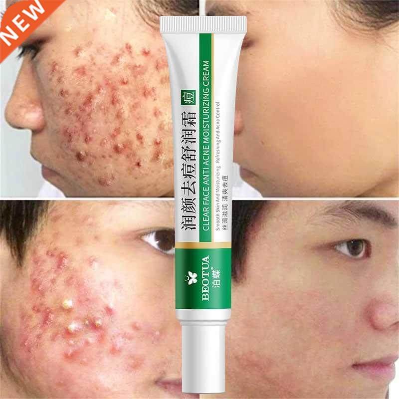 Effective Acne Removal Cream Herbal Acne Spots Oil Control A