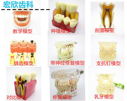 牙模型牙科教学牙齿模型假牙牙模型模具可拆卸龋齿模型支抗钉种植