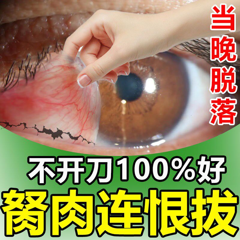 去除眼睛胬肉滴眼液眼睛长胬肉有异物感模糊看不清翼状胬肉眼水