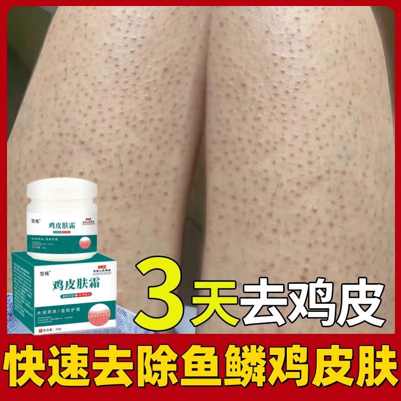 胳膊鸡皮肤疙瘩毛囊毛周角化去除症手臂脸上腿部药胳膊红点黑点膏