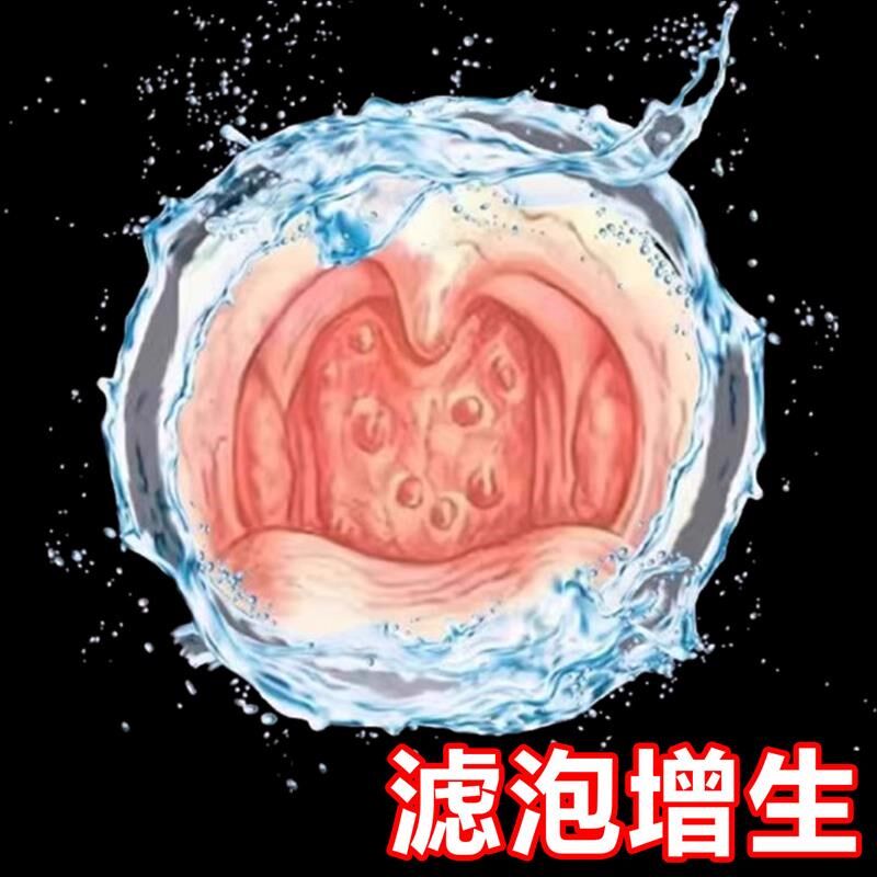 随喷随妤】喉咙滤泡增生咽喉焱淋巴滤泡舌根滤泡干痒咳嗽有异物感
