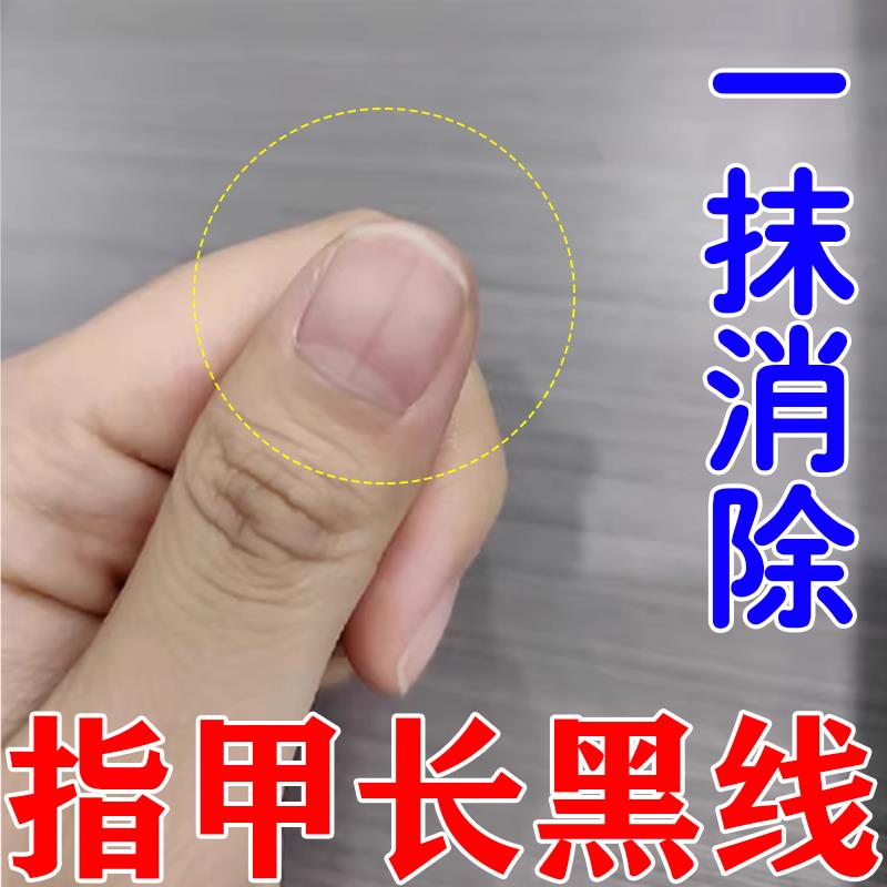 指甲有黑线甲下淤血空甲再生营养不良修复受损手脚指甲开裂护甲液
