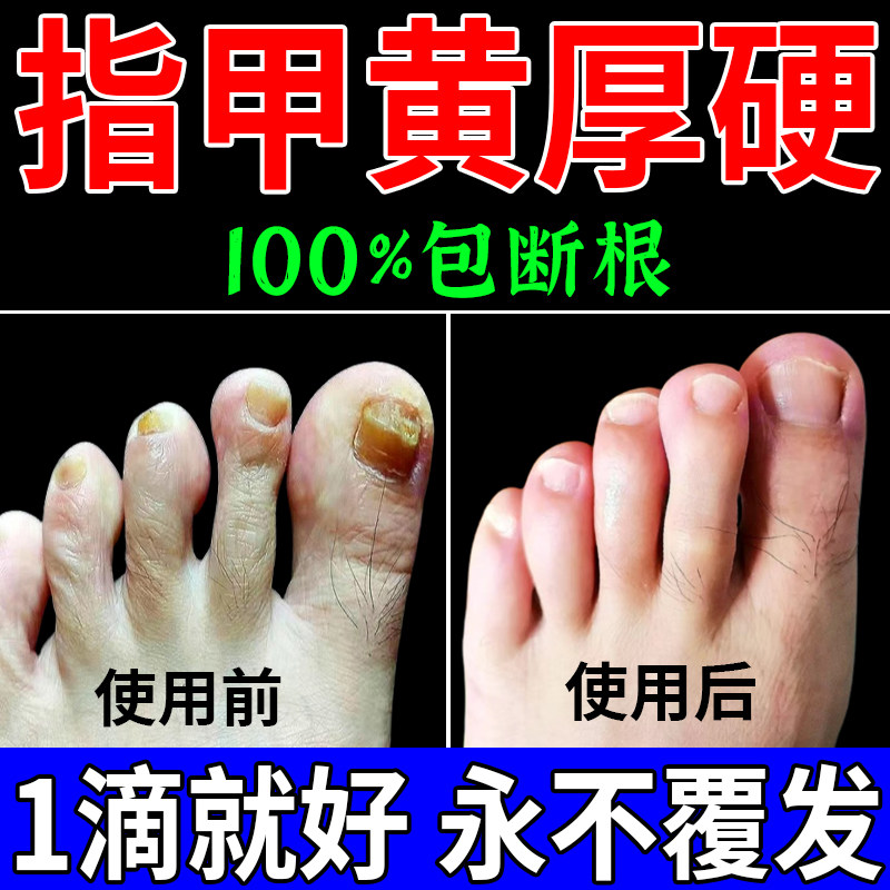 脚指甲发黄变厚趾甲增厚变硬真菌性白甲甲床分离空甲修复专用神器