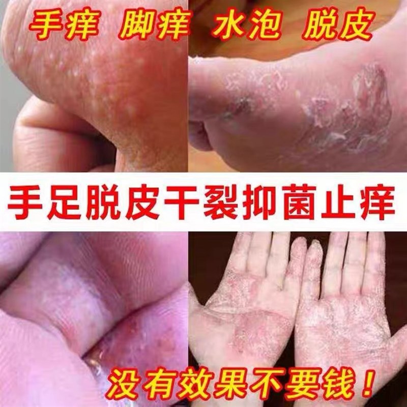 正品虎狼膏手痒起小水泡手上脱皮干裂苗医药痒膏