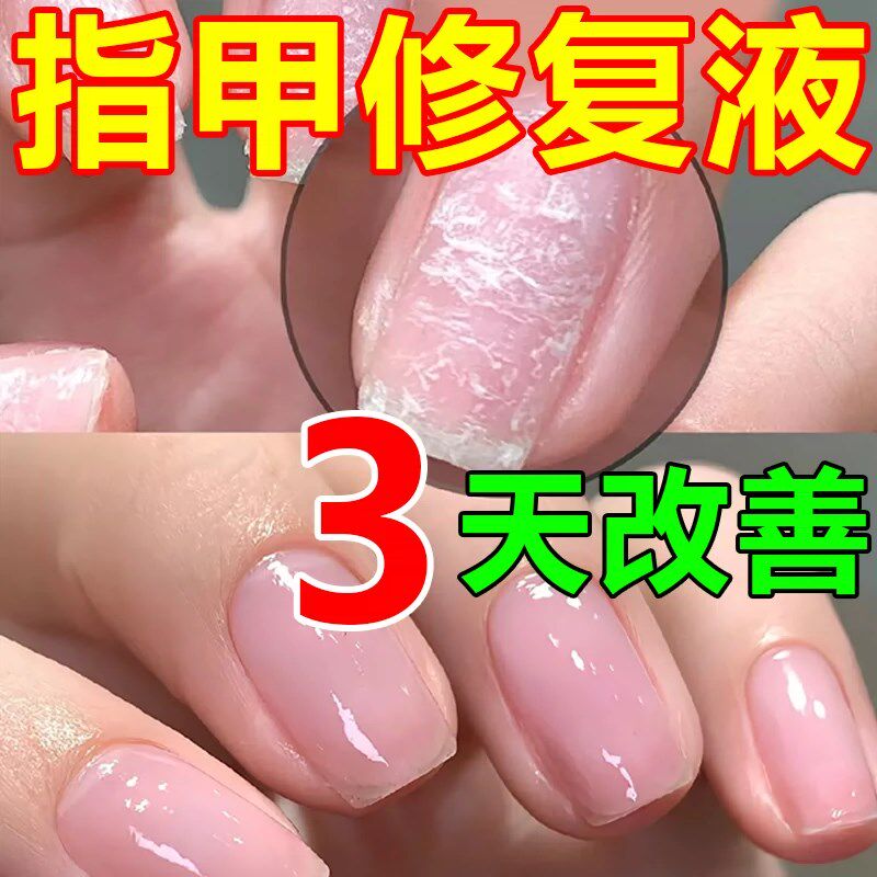 指甲薄软修覆防断裂增厚受损甲床甲肉分离竖纹分层护甲再生营养液