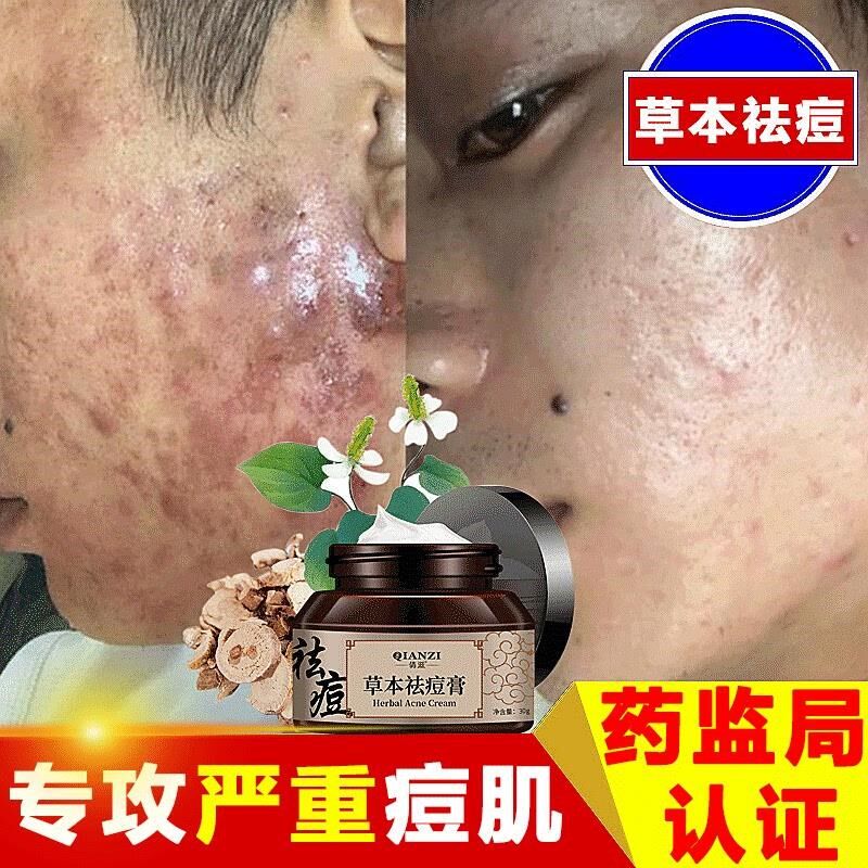 祛痘膏痤疮痘痘疤暗疮脸部下巴反复长痘红肿硬块青春痘草本祛痘霜