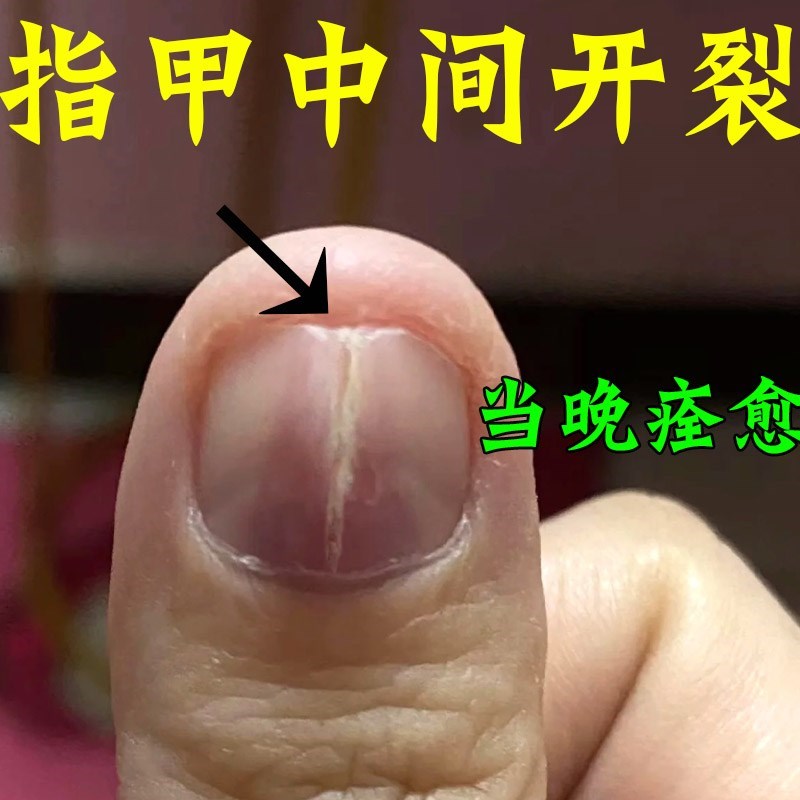 治指甲开裂修覆指甲竖纹受损甲肉分离甲面分层空甲凹凸不平修覆液