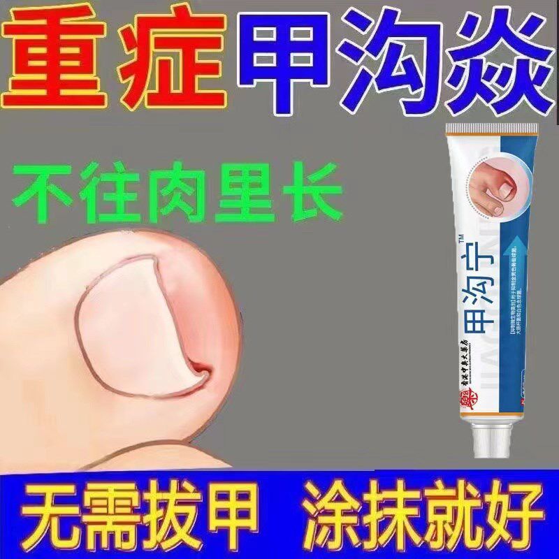 甲沟炎专用软甲嵌甲去肉芽脚趾矫正器软化息肉抑菌去除药膏