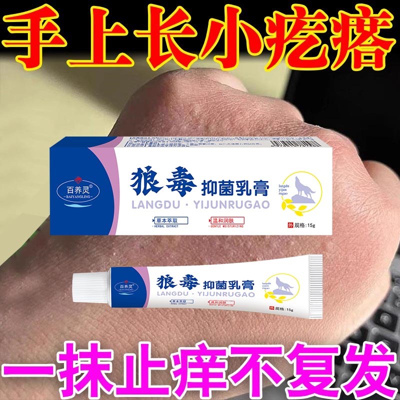 手癣手脱皮干裂汗泡疹足藓鹅掌风手上起小水泡手痒真菌感染止痒膏