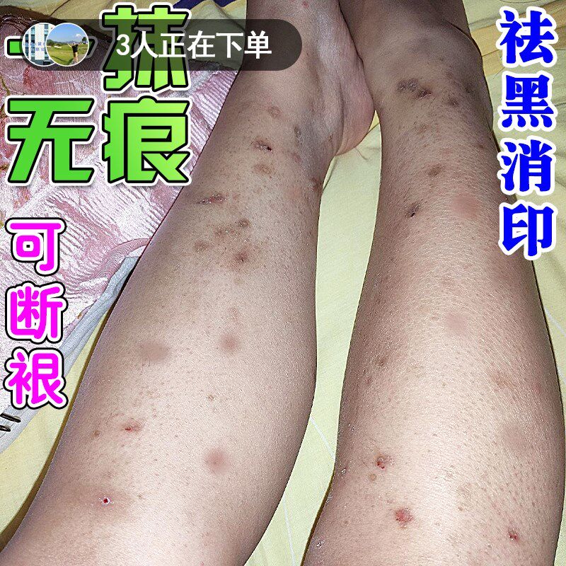 腿上挠印痘印烫伤疤痕蚊虫叮咬去黑印淡化黑色素沉淀去豆疤印消印