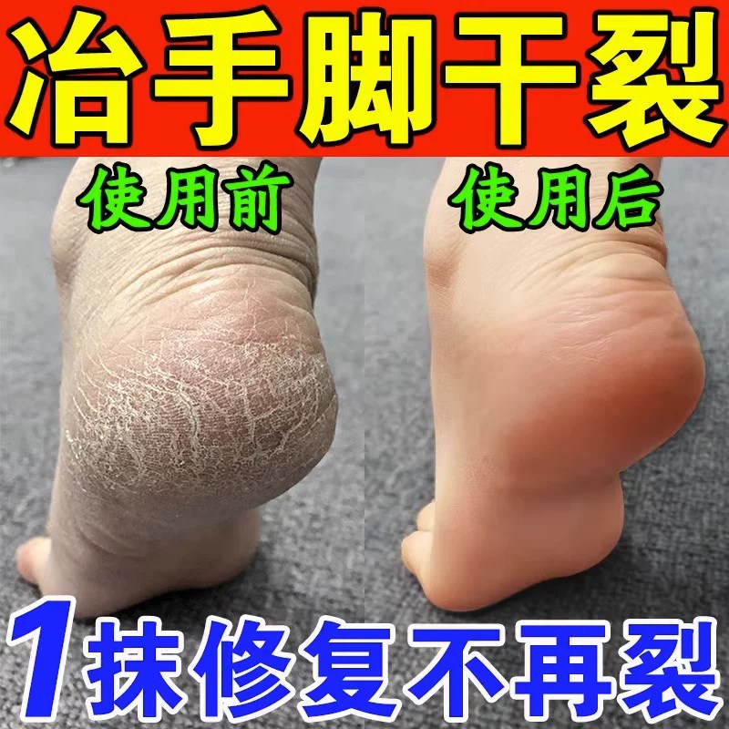 治脚裂脚后跟干裂/真菌脚底起硬皮足跟开裂脱皮修复霜防/裂