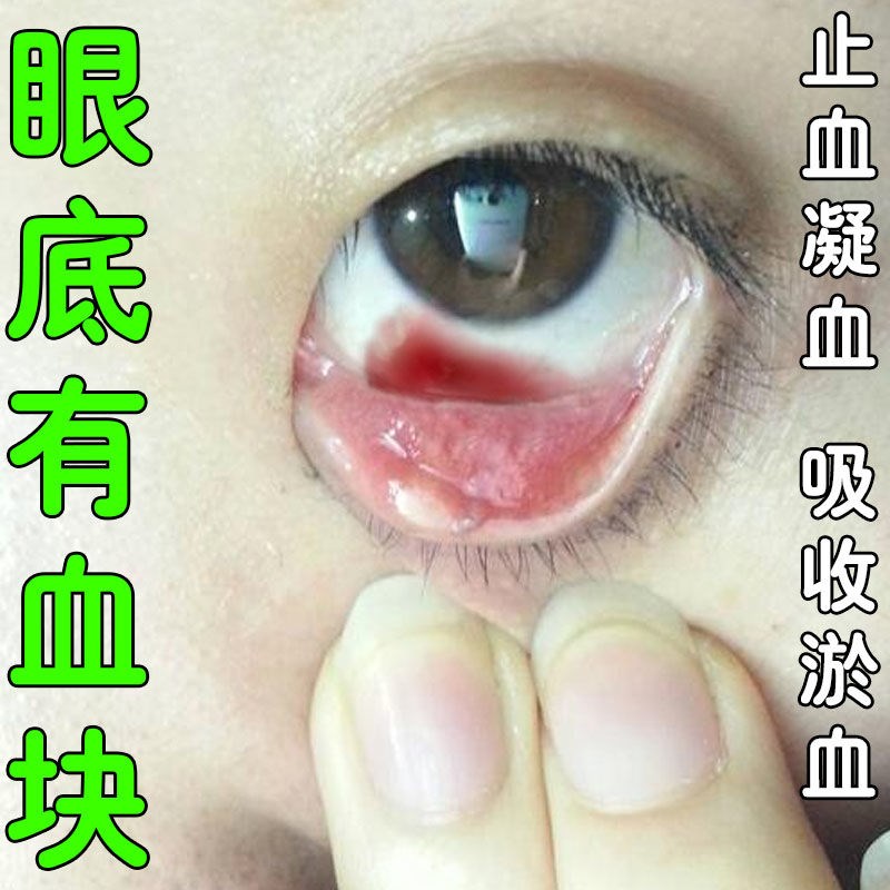 眼底有血块眼底出血识物下降黑影重影有异物感眼干眼部保健液水