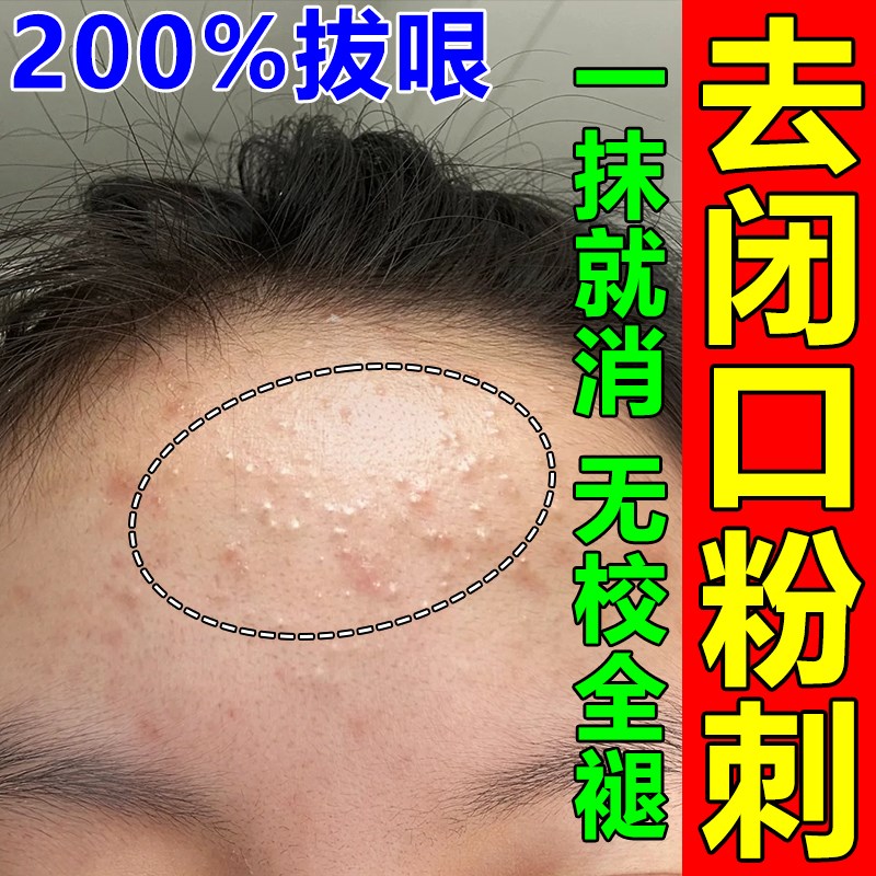 粉刺闭口去除脸部的克脸上长起小疙瘩逆光疹闭合粉刺额头祛