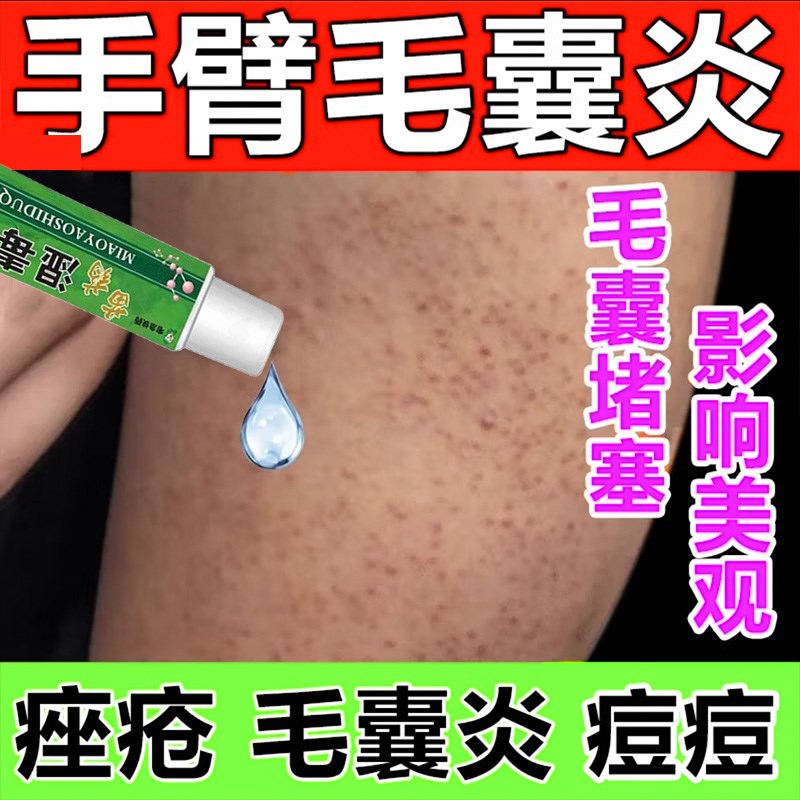 去胳膊上小颗粒凸起小红点修复手臂鸡皮疙瘩皮肤膏毛囊角化鸡皮肤