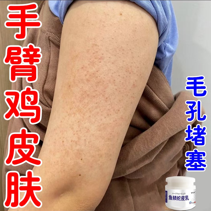 手臂鸡皮肤毛囊角化软膏去除腿部手臂全身疙瘩黑点毛囊堵塞专用