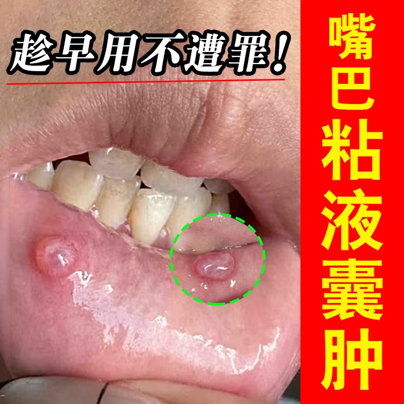 嘴起泡嘴皮里面粘液腺囊肿阻塞半透明痘痘口腔溃烂肿胀异物感上火