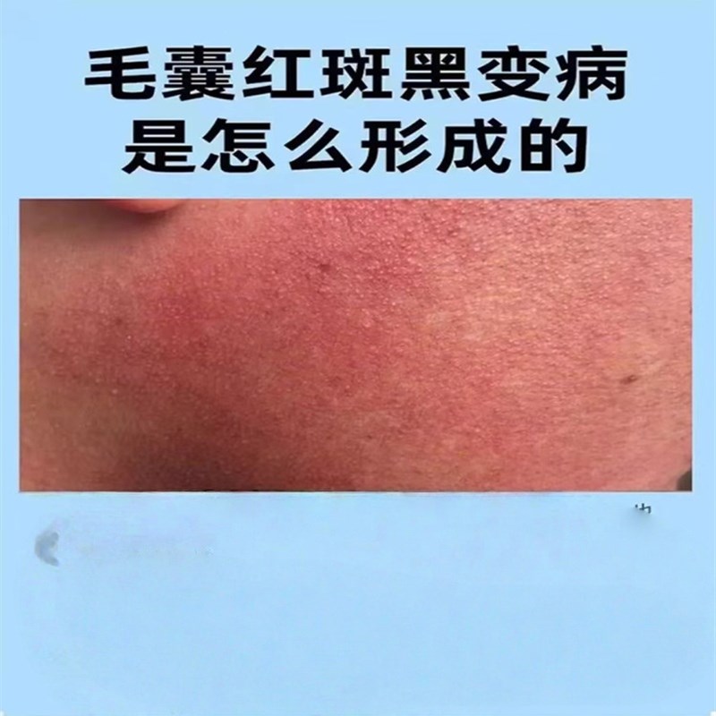 毛囊红斑黑变病毛周角化脸部泛红起小疙瘩鸡皮疙瘩毛孔粗大堵塞