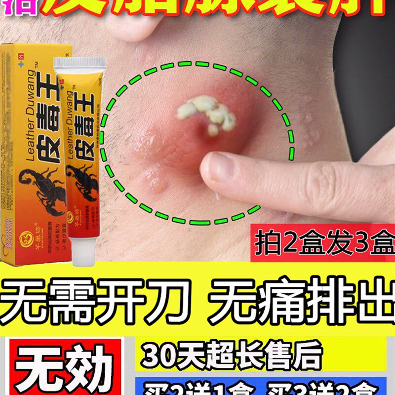 治大人屁股上长痘痘瘙痒火疖子拔毒膏乳膏屁股起疙瘩久坐坐板疮