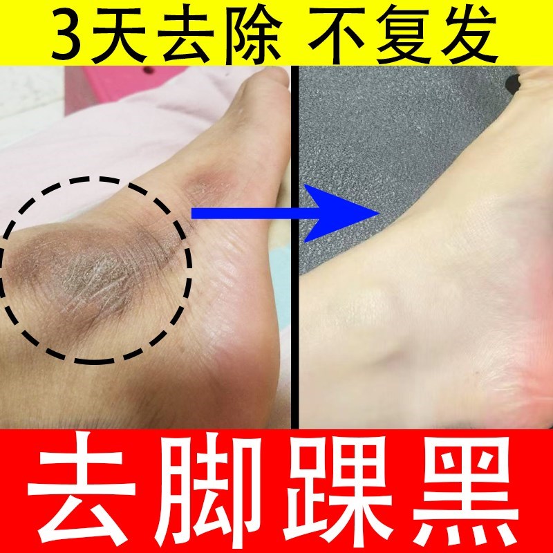 脚踝发黑脚脖黑色素沉淀去除腋下脖子膝盖手肘黑棘皮晒黑快速变白