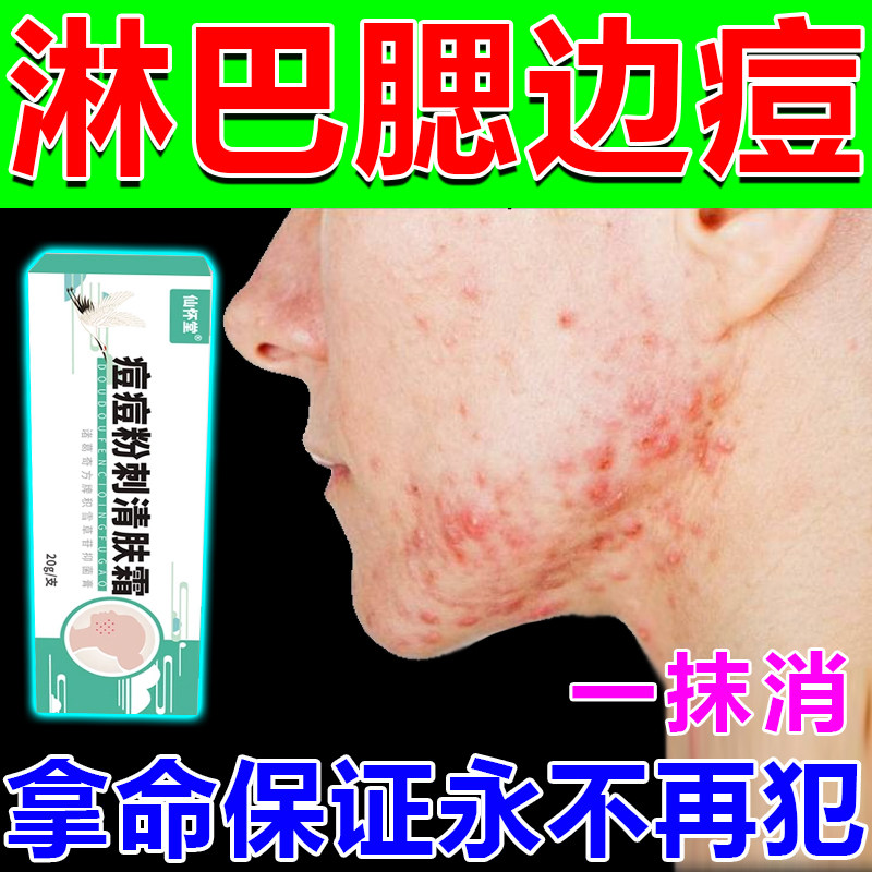 痤疮膏去淋巴痘闭口粉刺脸部祛痘药膏